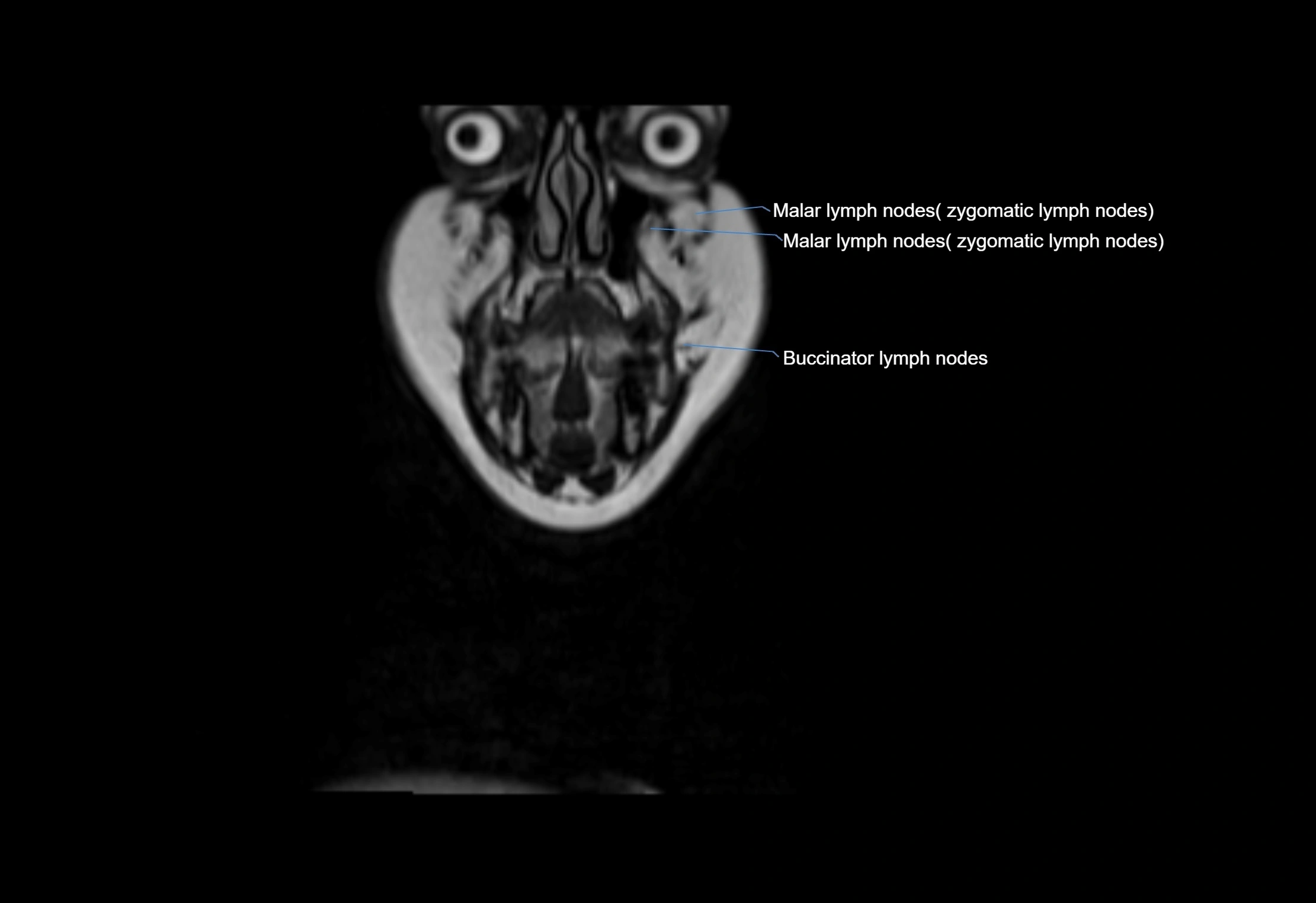 Neck coronal lymph node cross sectional MRI anatomy 3T MRI  image-img-00001-00069.webp